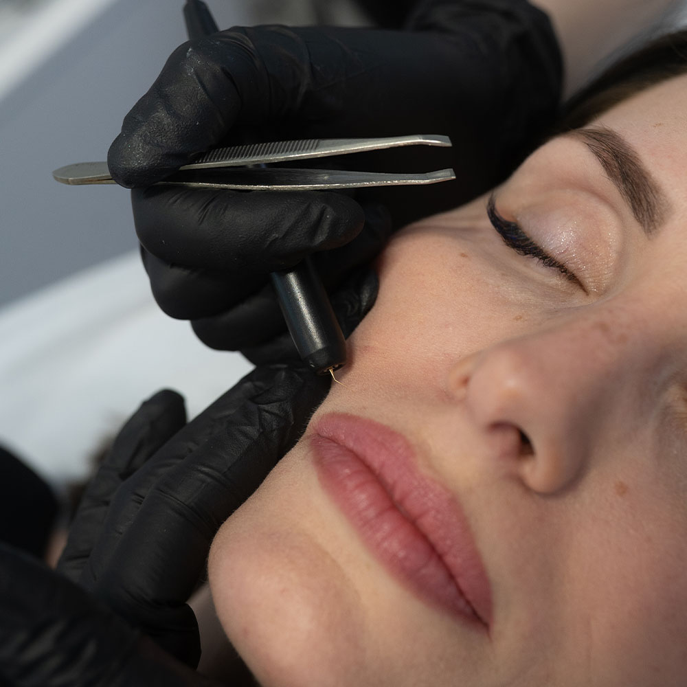 elektroepilacja twarzy Szczecin – usuwanie włosów prądem