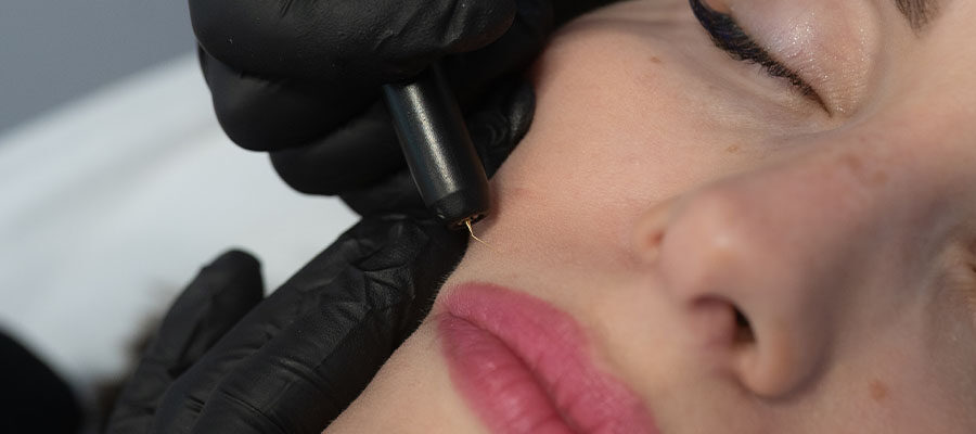 Elektroepilacja twarzy w Szczecinie