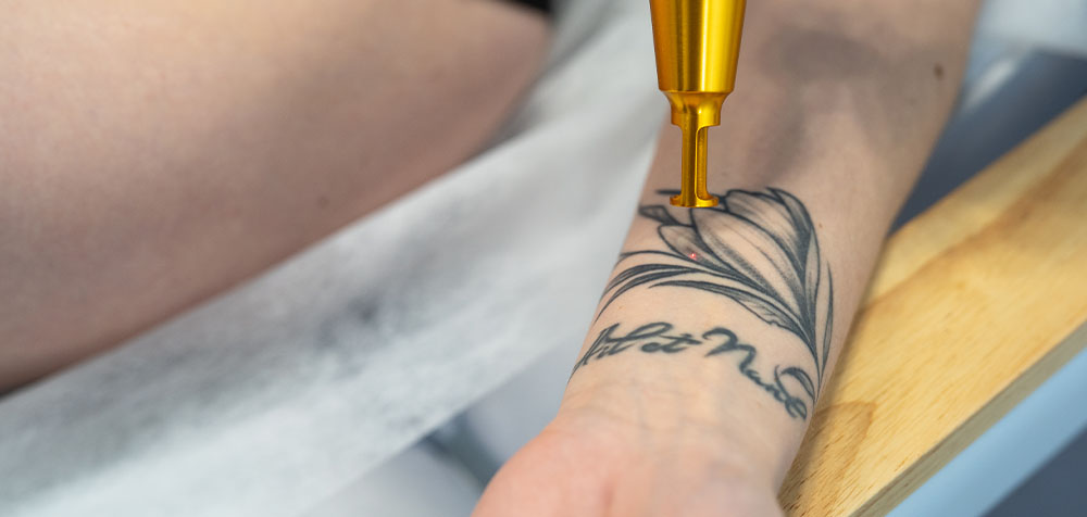 usuwanie tatuażu Szczecin Luxor Lasers